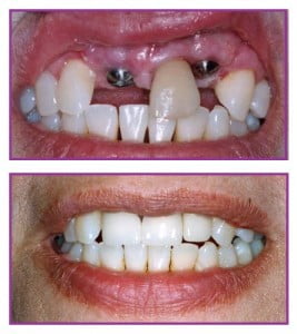 Trồng răng sứ bằng cấy ghép Implant