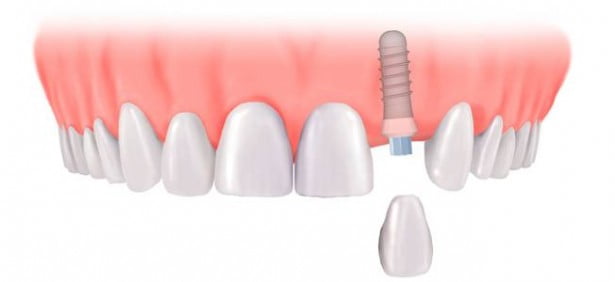 Trồng răng sứ bằng cấy ghép Implant