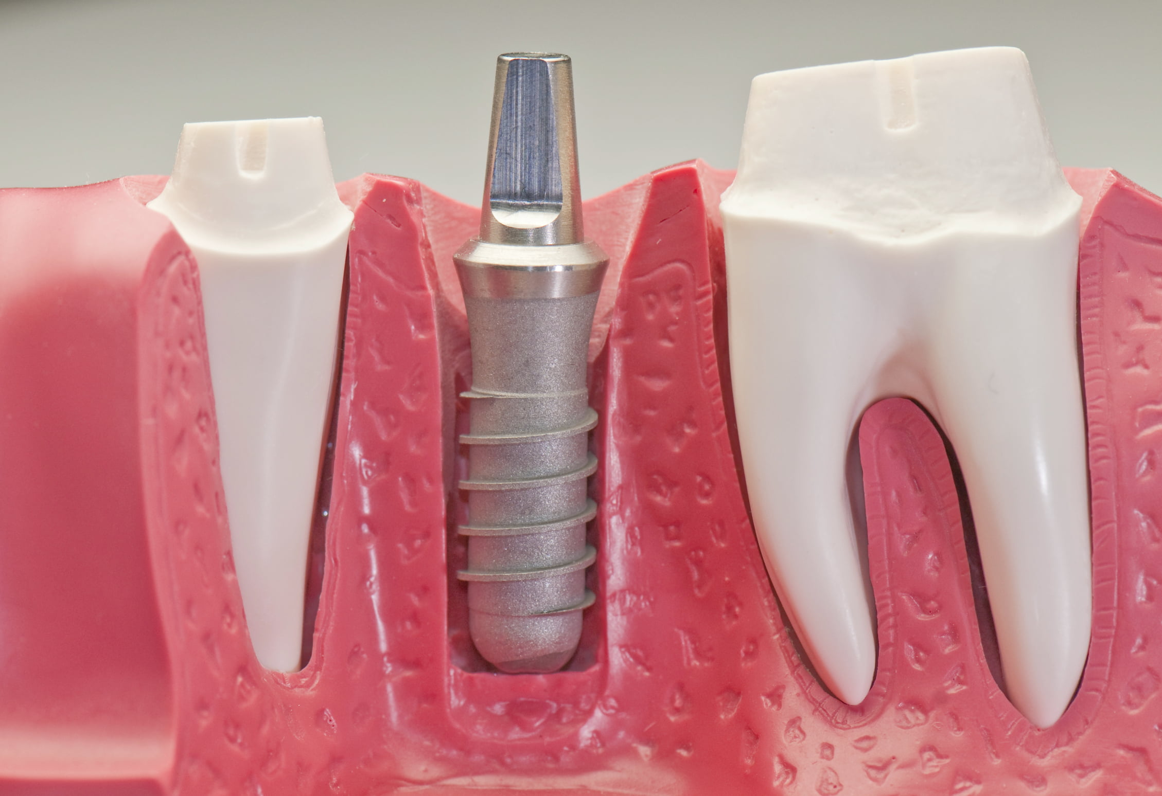 Ưu điểm của cấy ghép Implant so với làm cầu răng