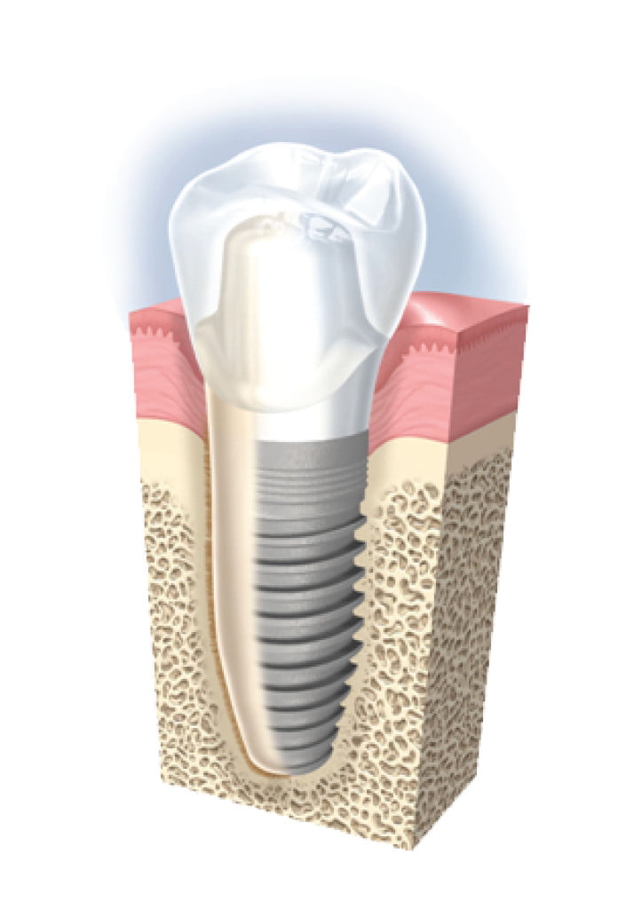 Vì sao trồng răng Implant lại có giá cao?