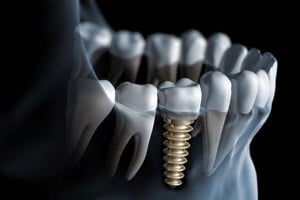 Ai không nên cấy ghép implant?