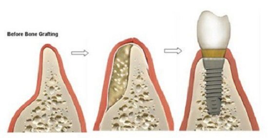 Trồng implant khi bị tiêu xương hàm