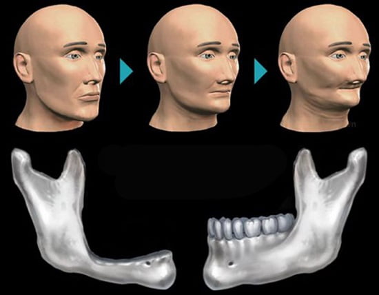 Trồng implant khi bị tiêu xương hàm