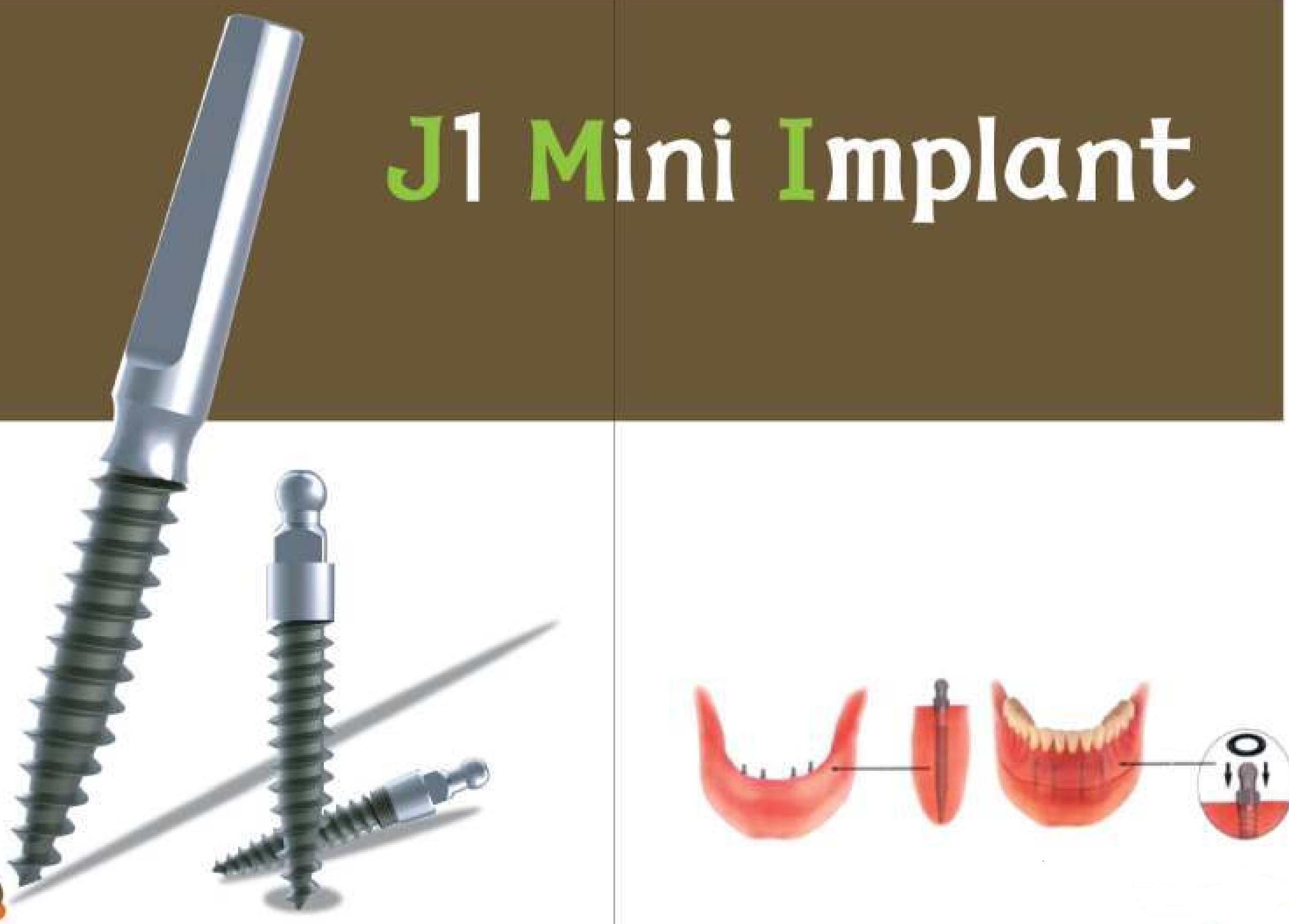 Kỹ thuật cấy ghép mini Implant