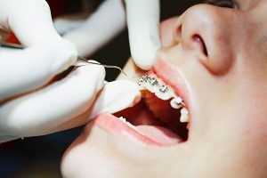 làm gì để giảm đau nhức sau khi niềng răng