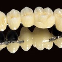 Bọc răng sứ titan an toàn hiệu quả