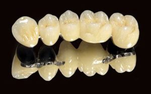 Bọc răng sứ titan an toàn hiệu quả