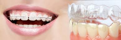 Niềng răng invisalign trong suốt thẩm mỹ