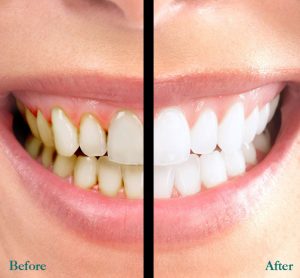 Tẩy trắng răng an toàn hiệu quả tại nha khoa