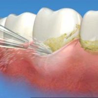 địa chỉ tẩy trắng răng uy tín tại tphcm