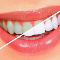 Cạo vôi răng có lợi hay hại cho răng?