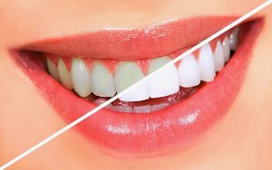 Cạo vôi răng có lợi hay hại cho răng?
