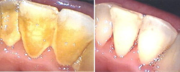 những cách tẩy trắng răng tại nha khoa