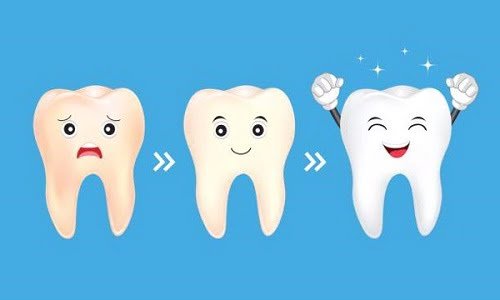 Tẩy trắng răng bằng laser whitening bao nhiêu tiền? 2 Tẩy trắng răng bằng laser whitening bao nhiêu tiền? 2