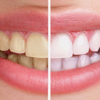 Tẩy trắng răng có nguy hiểm không