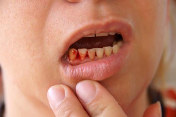 bệnh chảy máu chân răng ở phụ nữ khi mang thai