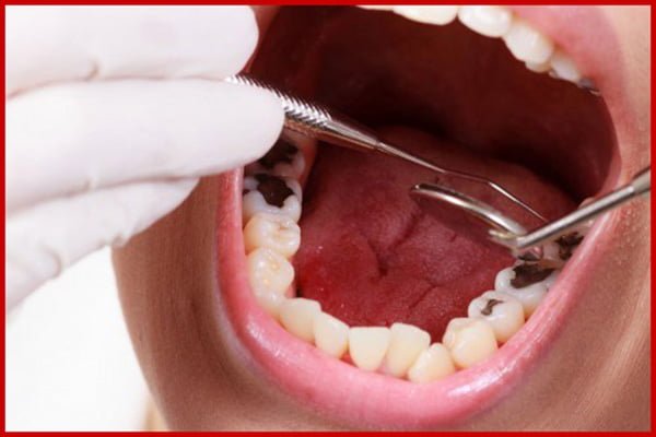 cách điều trị viêm chân răng có mủ
