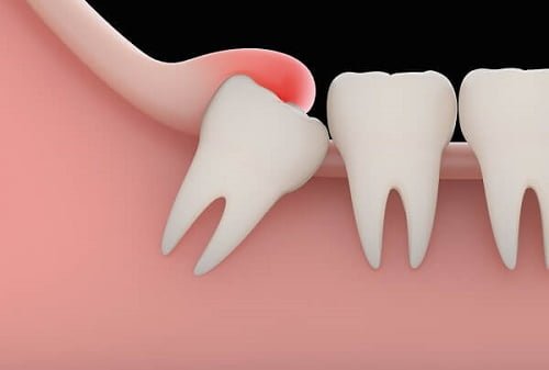 Dấu hiệu và triệu chứng mọc răng khôn 1