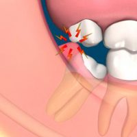 làm gì khi răng khôn hàm dưới mọc lệch