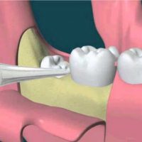 mọc răng khôn khi mang thai có sao không