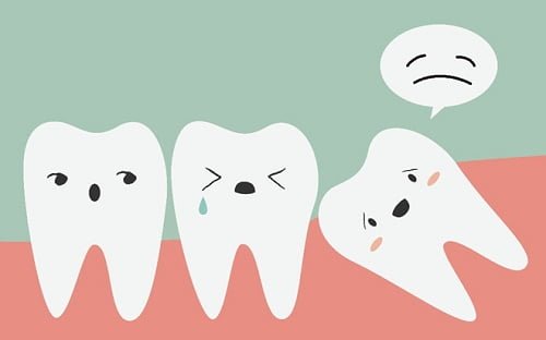 Nhổ răng khôn phải kiêng những gì? 1