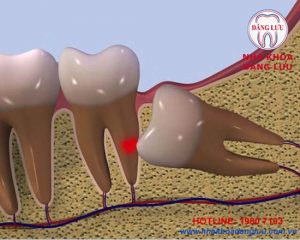 răng khôn mọc ở vị trí nào trong hàm răng