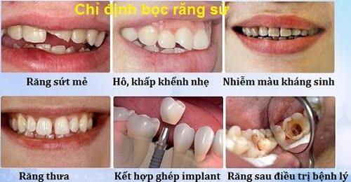 Bọc răng sứ cho răng hàm với những đối tượng nào? 2