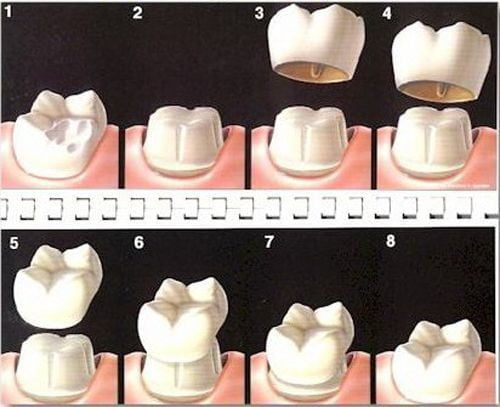Bọc răng sứ cho răng hàm với những đối tượng nào? 4