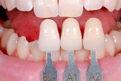 Bọc răng sứ cho răng hô tiết kiệm thời gian điều trị hô 1 Bọc răng sứ cho răng hô tiết kiệm thời gian điều trị hô 1