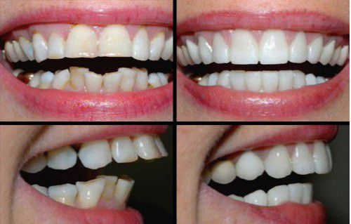 Bọc răng sứ cho răng hô tiết kiệm thời gian điều trị hô 2