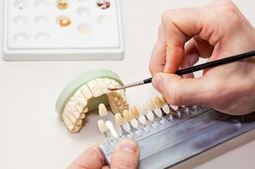 Bọc răng sứ cho răng hô tiết kiệm thời gian điều trị hô 4