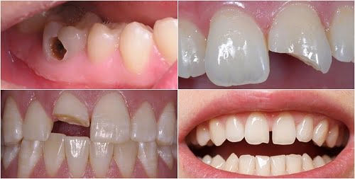 Bọc răng sứ cho răng khấp khểnh giúp răng đều đặn 2