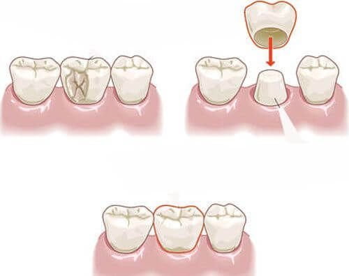 Bọc răng sứ cho răng sâu để hàm răng chắc khỏe 2