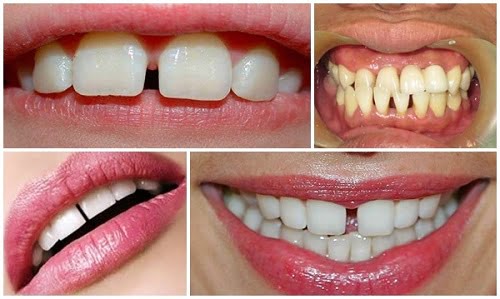 Bọc răng sứ cho răng thưa có ưu điểm gì không? 1