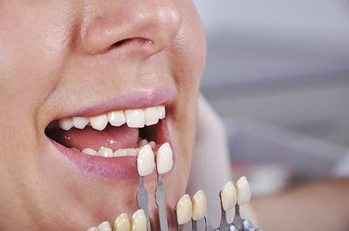 Bọc răng sứ cho răng thưa có ưu điểm gì không? 4