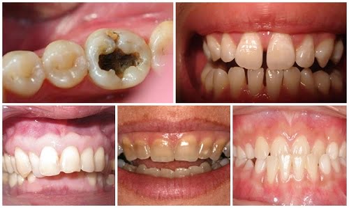 Bọc răng sứ được bao lâu thì thay răng sứ mới? 1