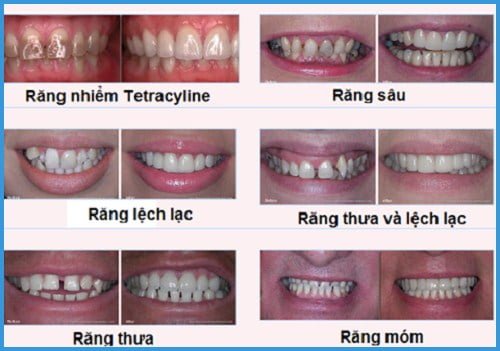 Bọc răng sứ mất bao lâu? Áp dụng cho những ai? 2