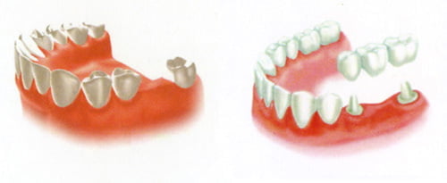Bọc răng sứ mất bao lâu? Áp dụng cho những ai? 3