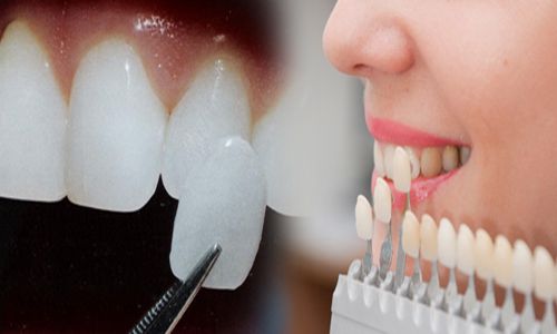 Bọc răng sứ veneer - Các đối tượng phù hợp nhất 1