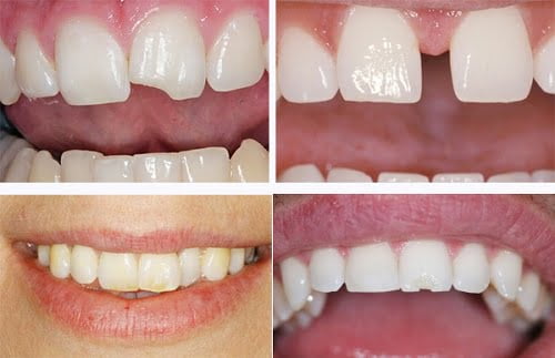 Bọc răng sứ veneer - Các đối tượng phù hợp nhất 2