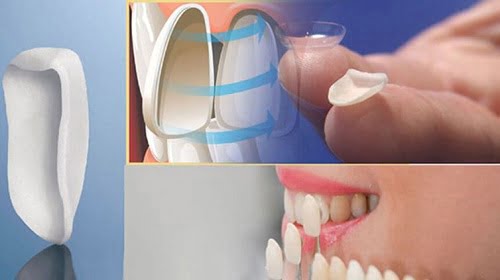 Bọc răng sứ veneer - Các đối tượng phù hợp nhất 3 Bọc răng sứ veneer - Các đối tượng phù hợp nhất 3