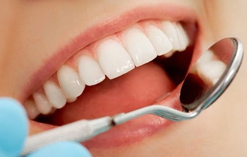 Bọc răng sứ veneer - Các đối tượng phù hợp nhất 4