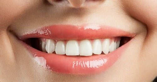 Bọc sứ răng cửa cho hàm răng trắng khỏe linh hoạt 1