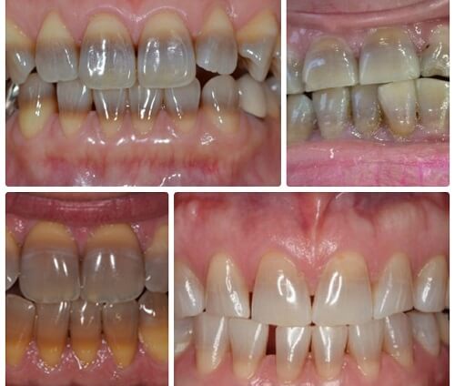 Bọc sứ răng cửa cho hàm răng trắng khỏe linh hoạt 2