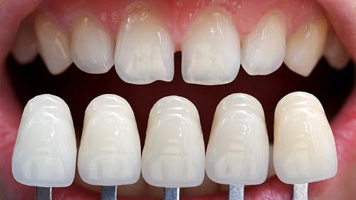 Bọc sứ răng cửa cho hàm răng trắng khỏe linh hoạt 4