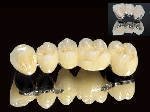 Các loại răng sứ được khách hàng yêu thích nhất 3