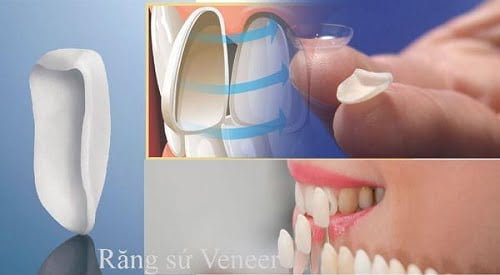 Giá bọc răng sứ veneer áp dụng năm 2019 1