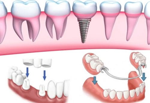 Làm răng giả - Phương pháp phục hình răng hiện đại 4
