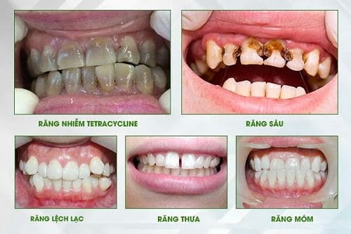 Làm răng sứ cho hàm răng chắc khỏe nụ cười thẩm mỹ 2