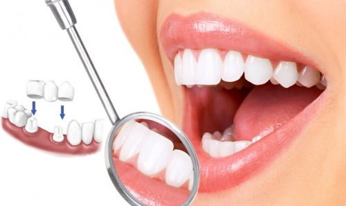 Răng bọc sứ bị lung lay nên làm gì hay nhất? 3